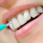 Dentistas alertam sobre clareamento caseiro: “Pode causar danos”